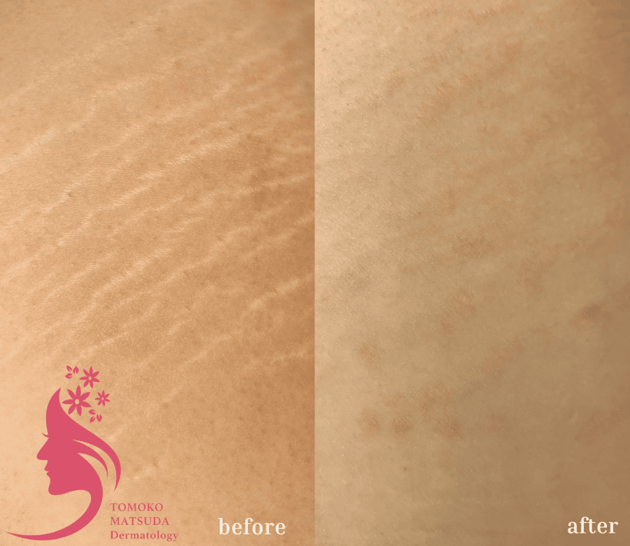 ストレッチマーク