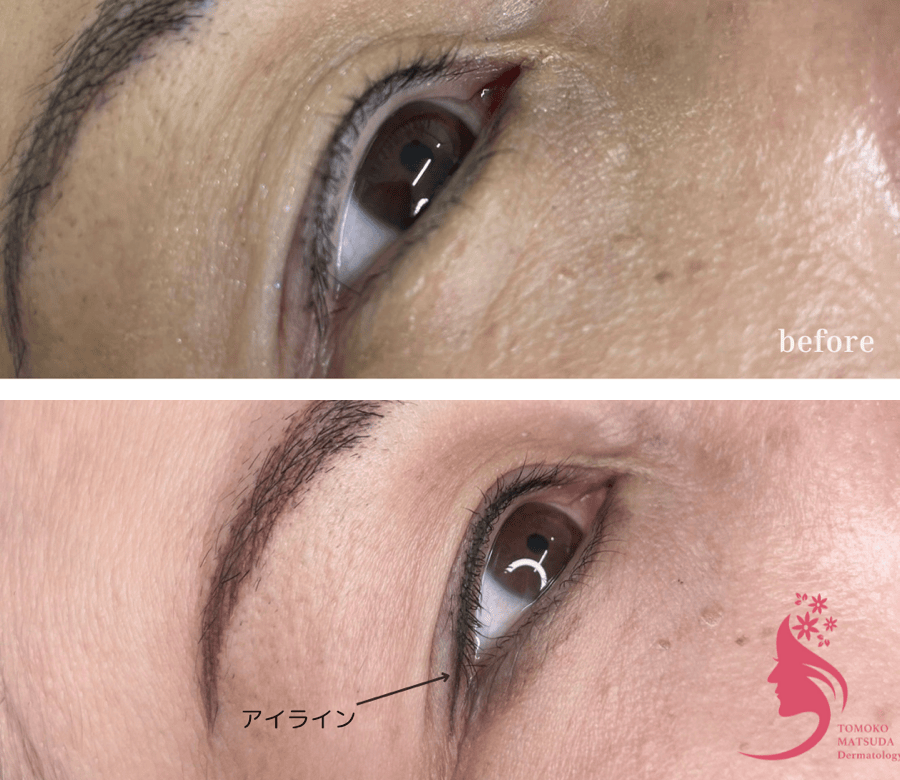 アイライン