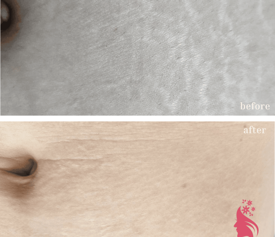 ストレッチマーク