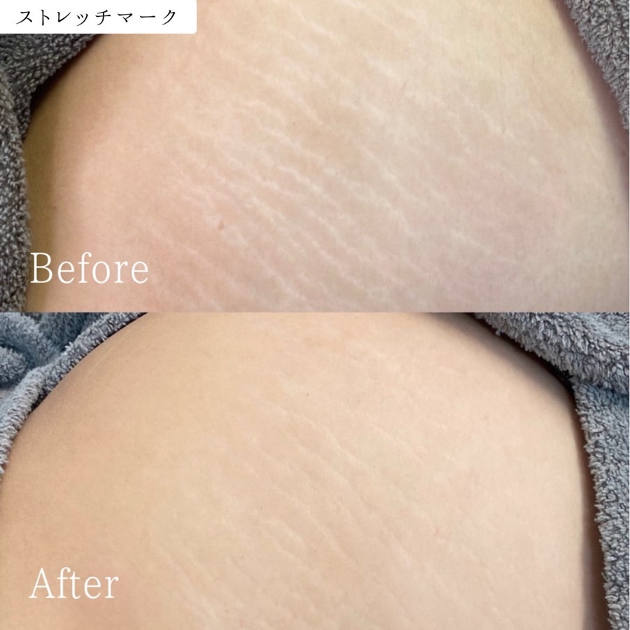 ストレッチマーク